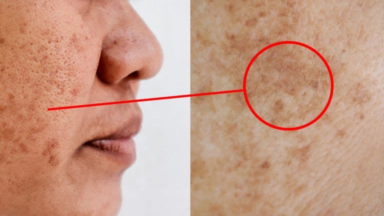 melasma