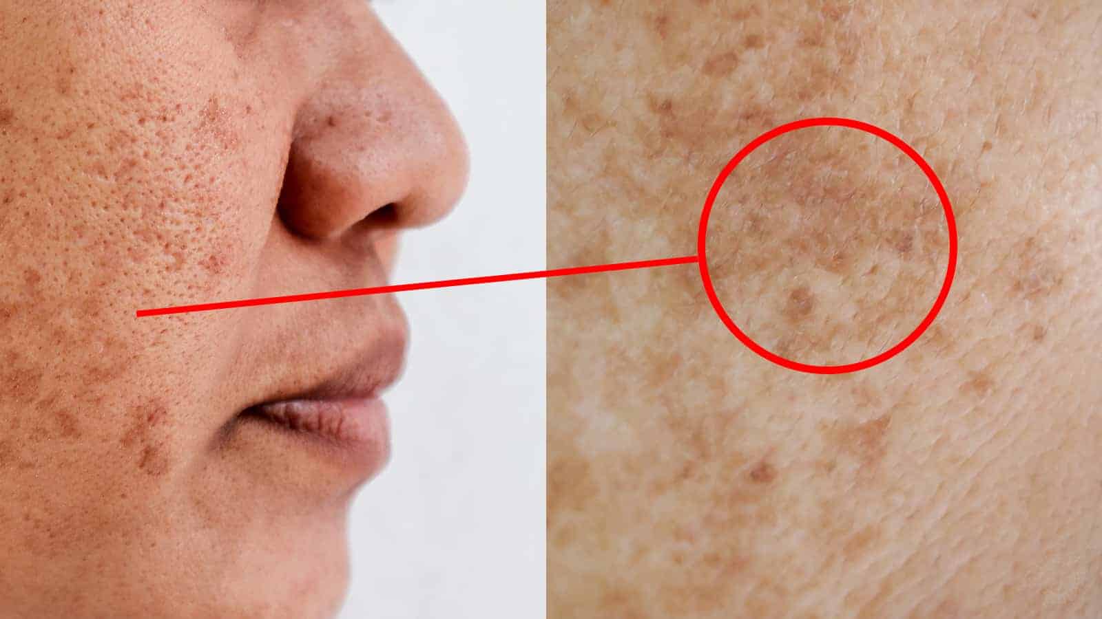 Science Explains The Signs of Melasma (And Why It Happens)