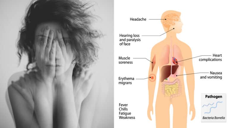 lyme disease
