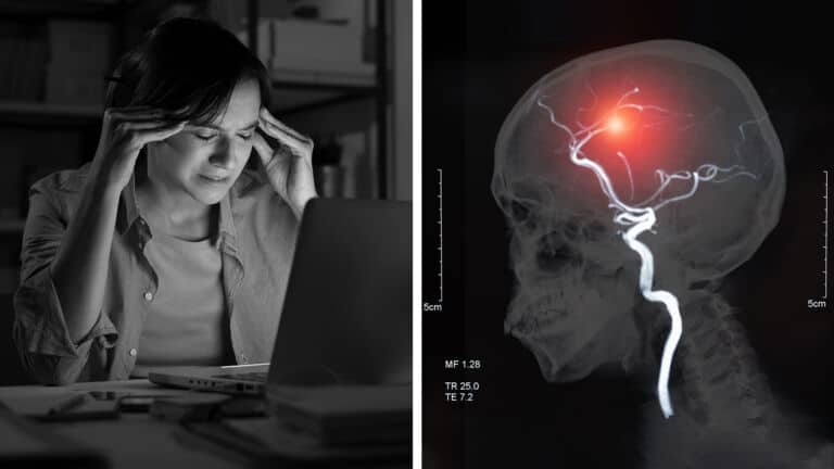 stroke risk