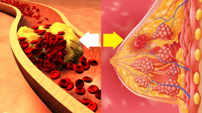 breast cancer cell