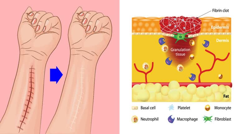 wound healing