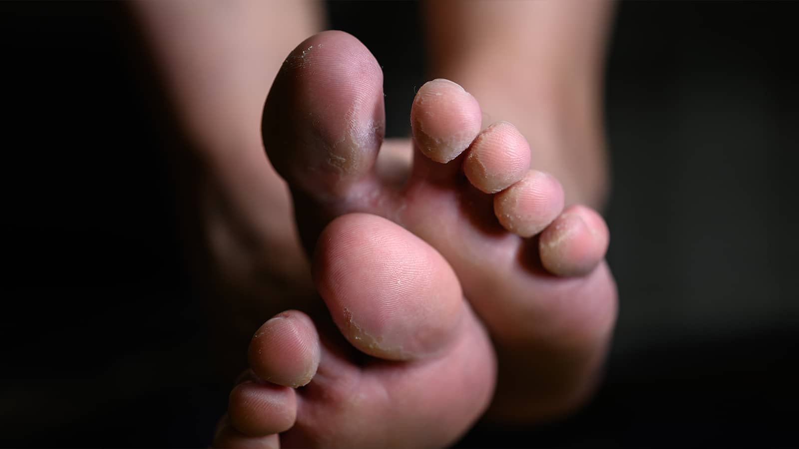 7 Causes of Stinky Feet (and How to Fix It)