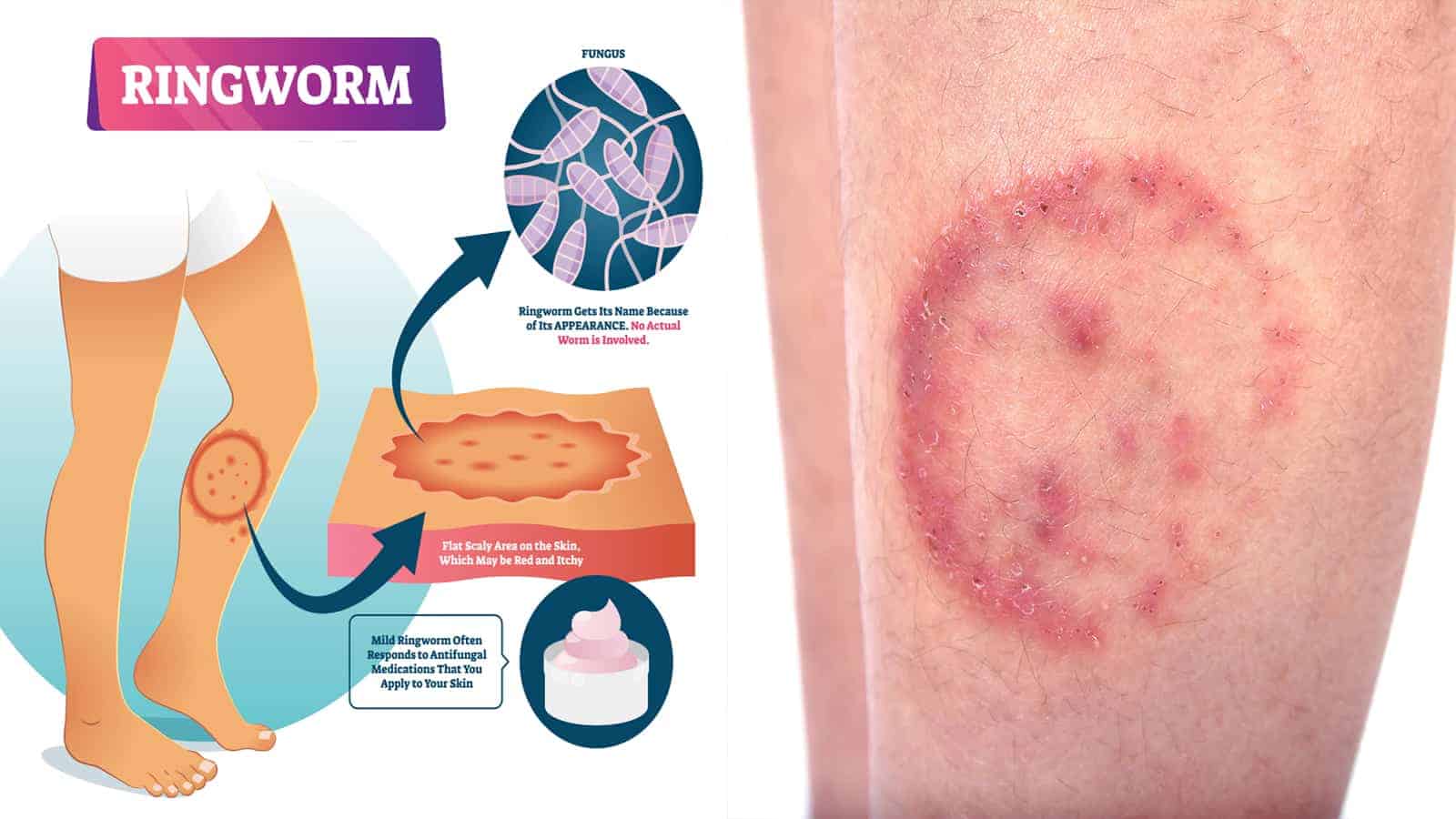 Ringworm Symptoms, Causes, and Treatments Never to Ignore