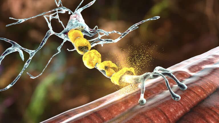 small fiber neuropathy