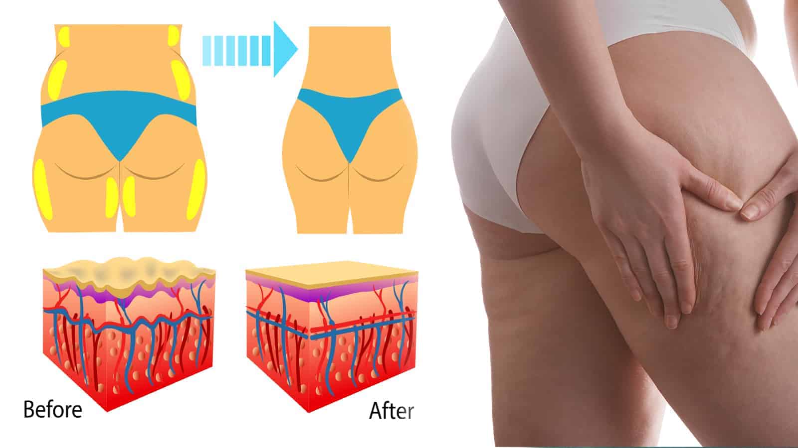 15 Science-Backed Tips to Reduce Cellulite