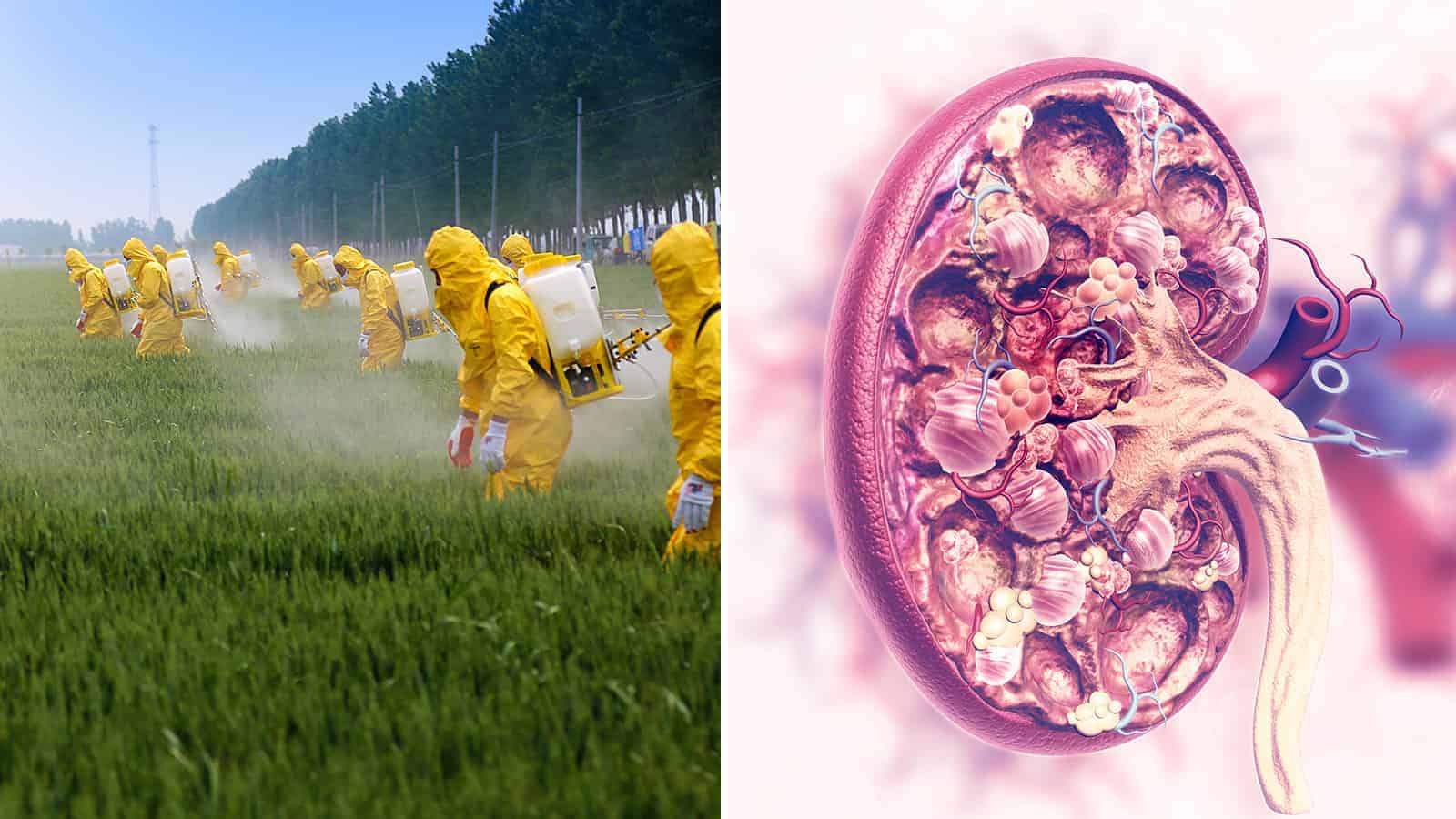 Australian Researchers Link Pesticides to Chronic Kidney Disease