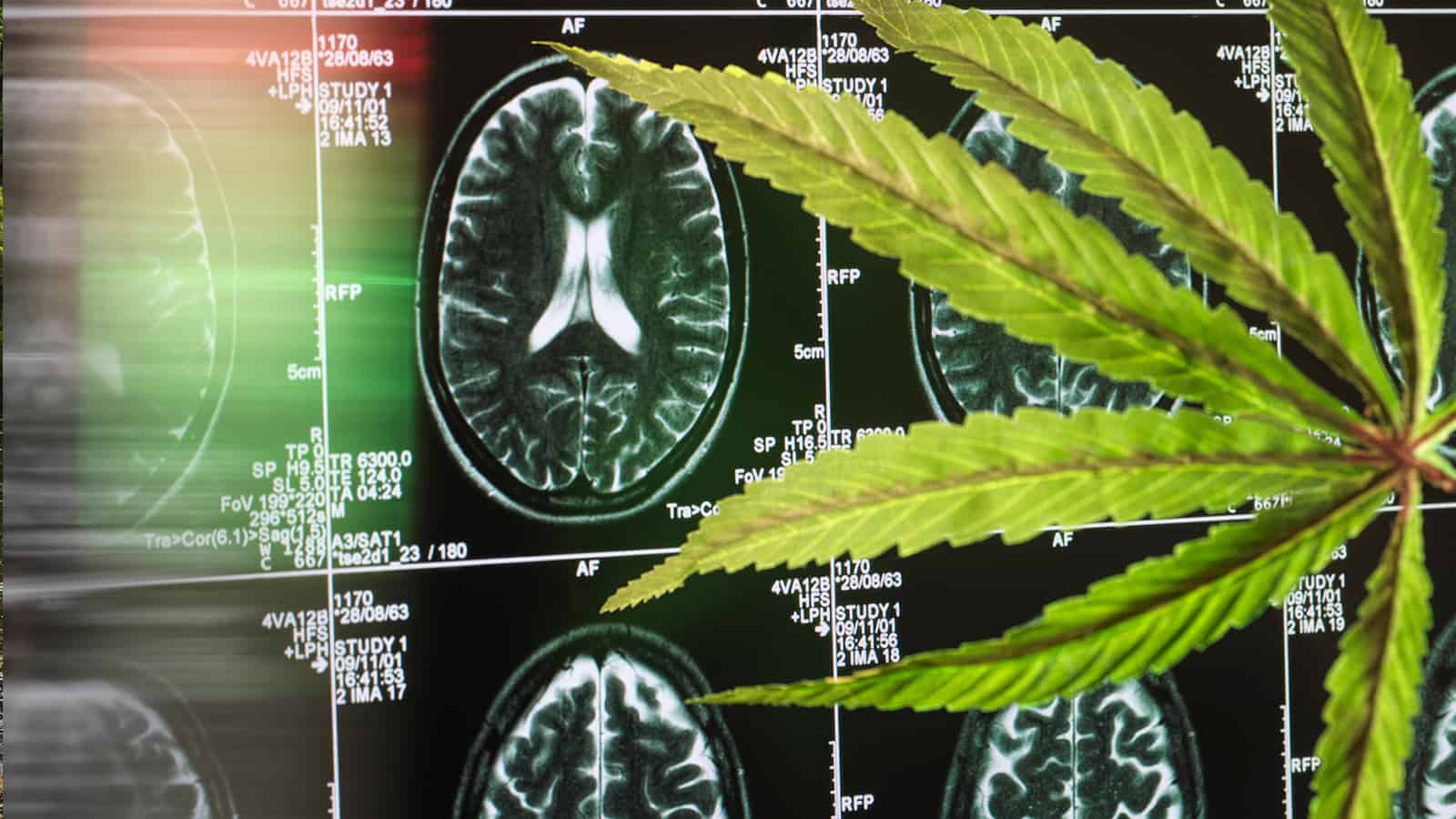 Researchers Reveal How Cannabis Can Help Prevent Parkinson’s and Alzheimer’s
