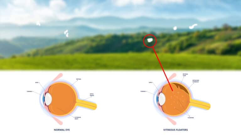 eye floaters