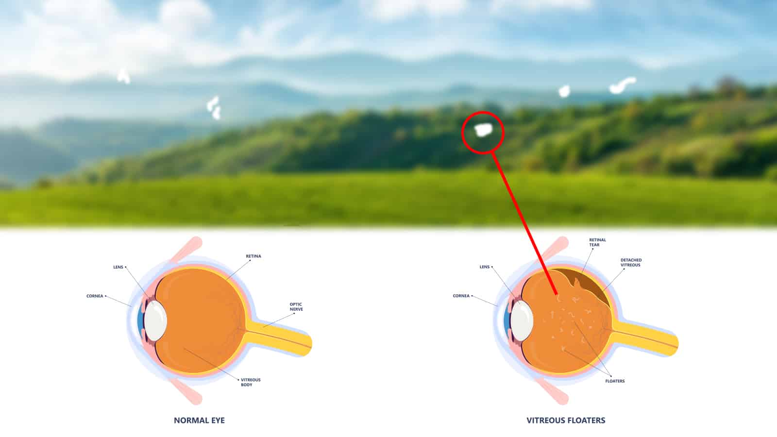 Science Explains What It Means When You See Eye Floaters