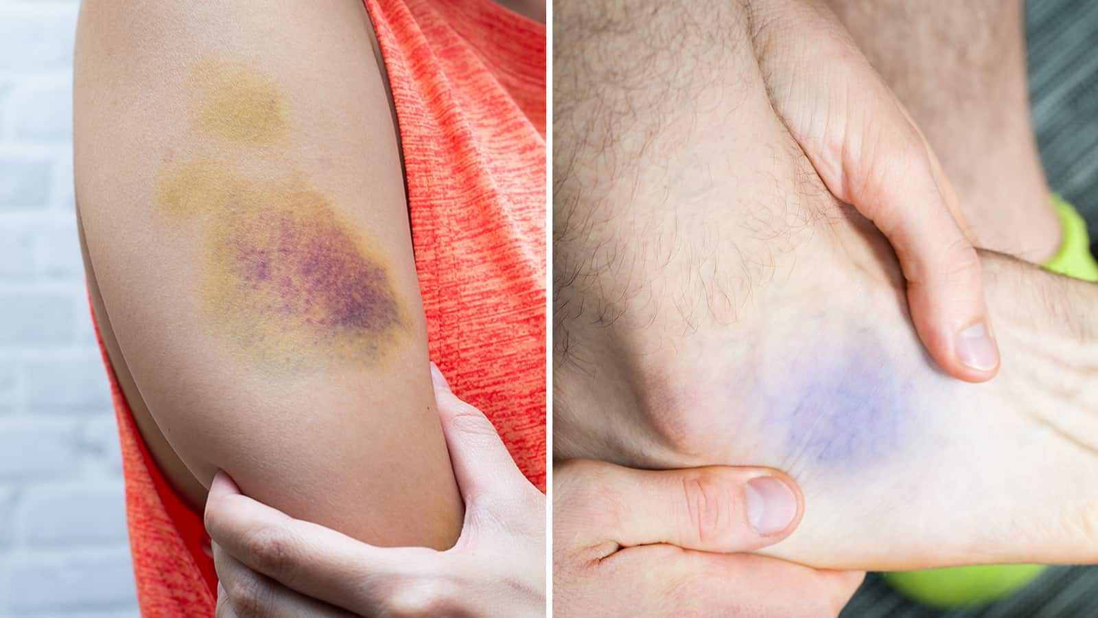 17 Reasons for Skin Bruising Never to Ignore