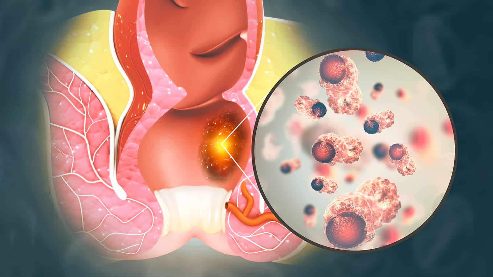 8 Signs of Anal Cancer Never to Ignore