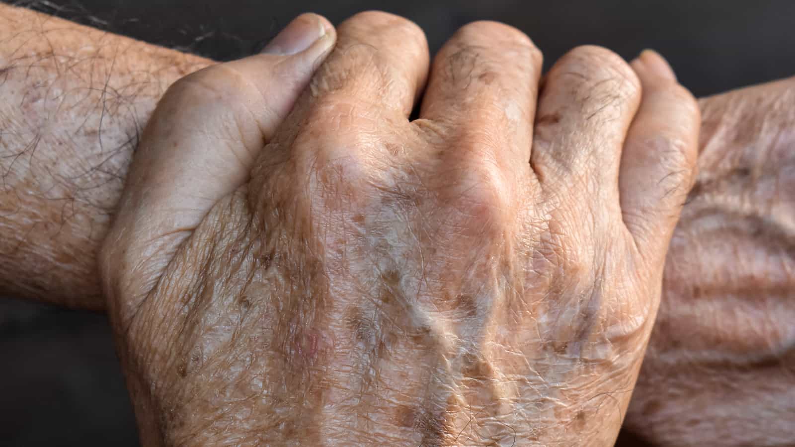 8 Things That Cause Dark Spots on the Hands (and How to Fix Them)