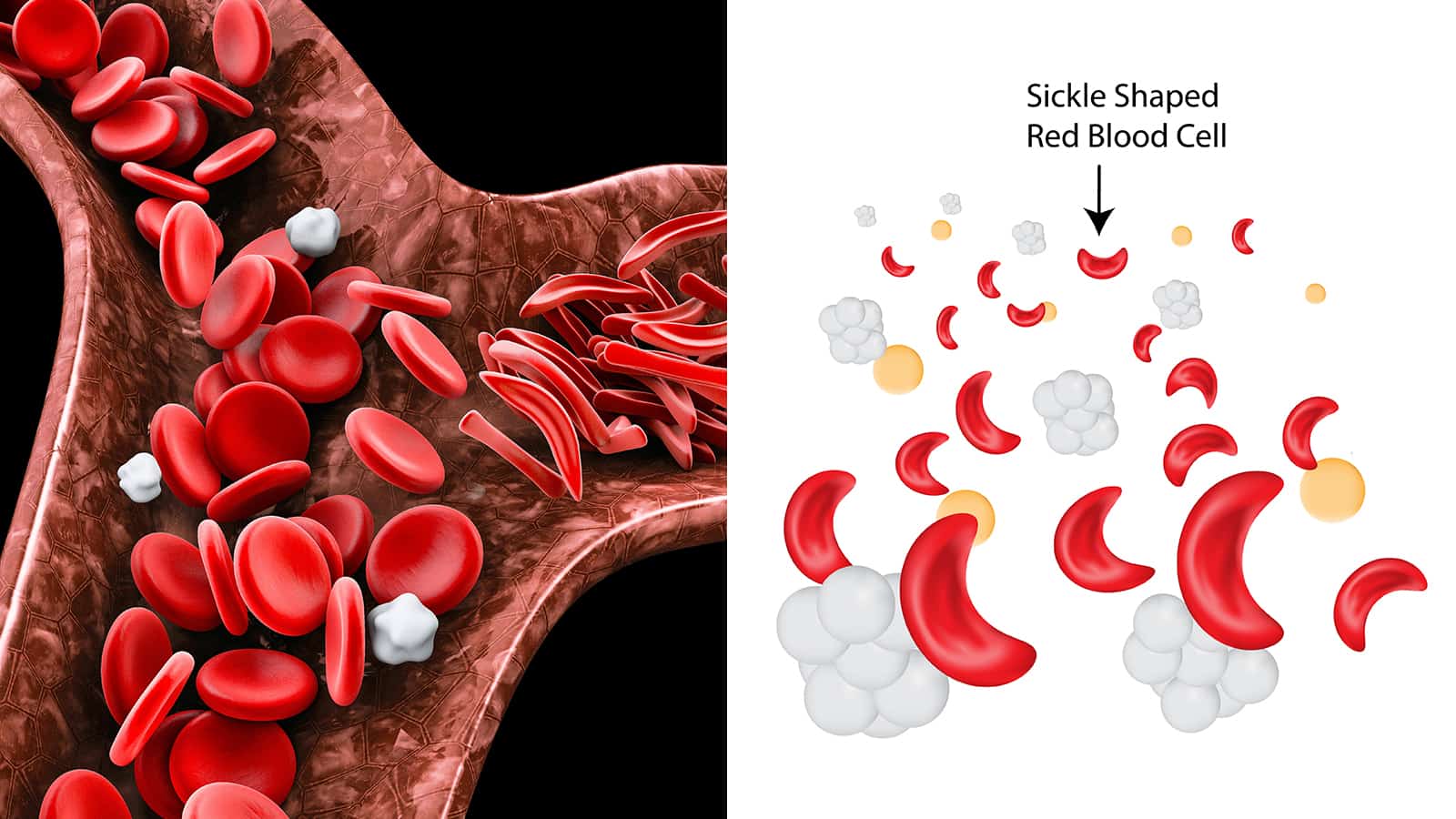 sickle cell anemia