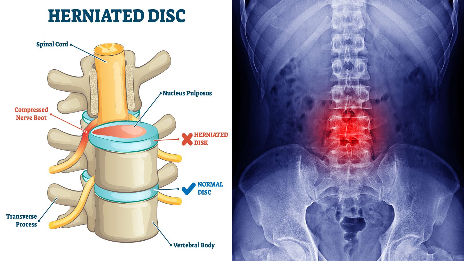  15 Signs of a Herniated Disc Never to Ignore 