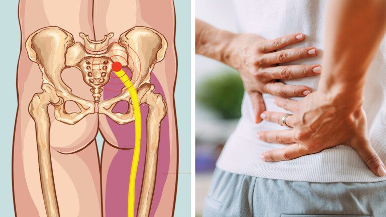 signs of sciatica