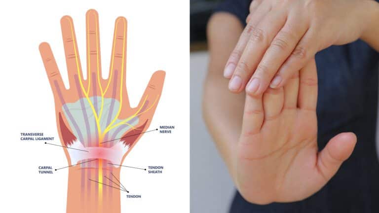 carpal tunnel