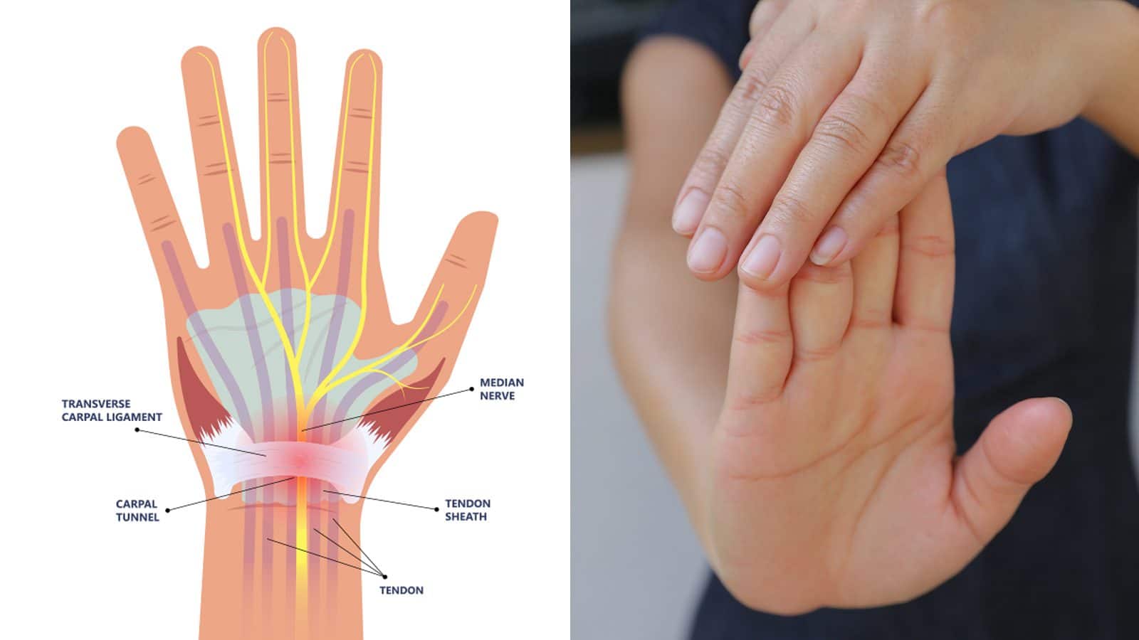7 Exercises for Carpal Tunnel Syndrome to Do at Home