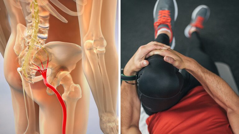 sciatica