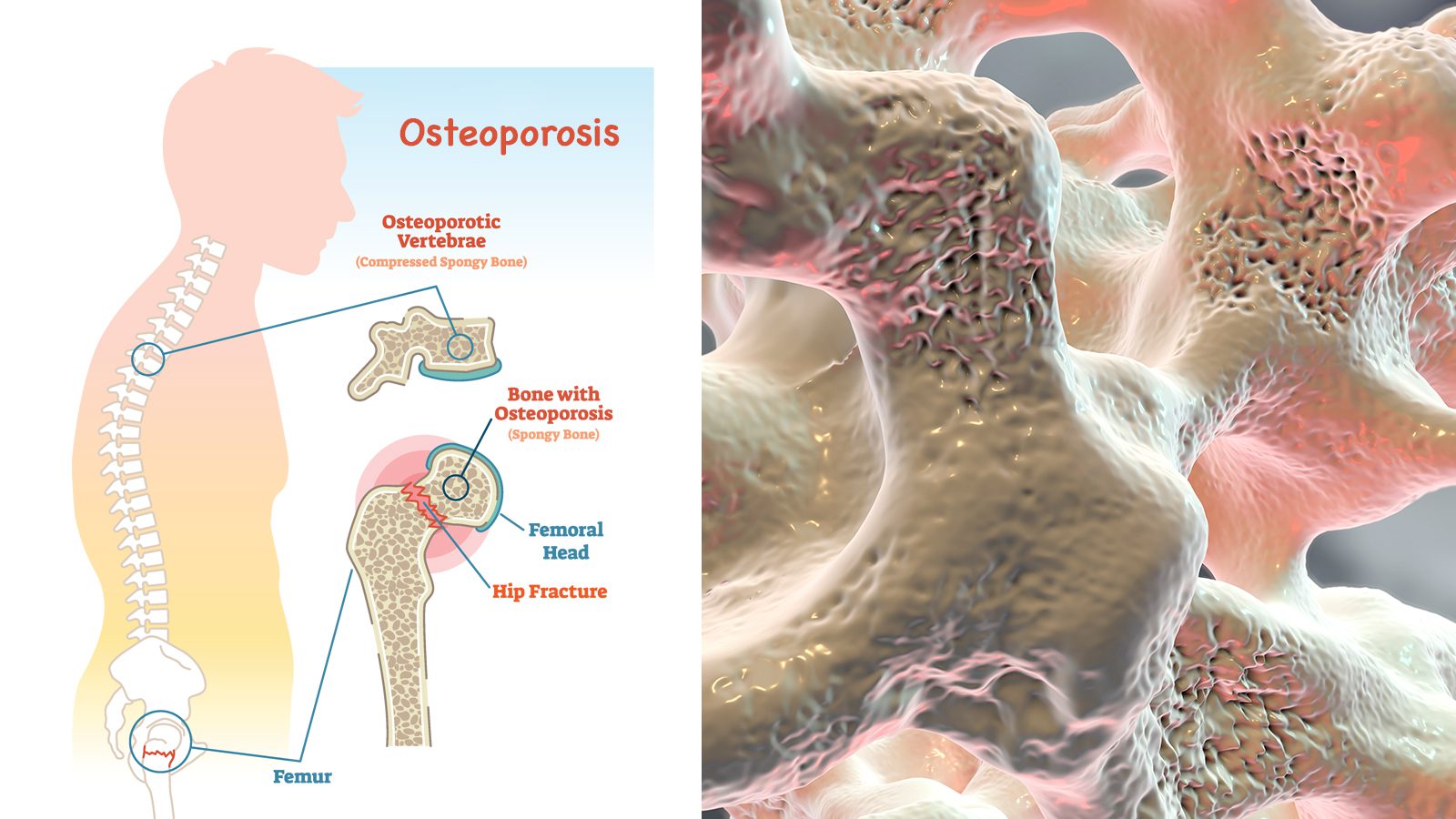 4 Causes of Osteoporosis (and How to Avoid It)