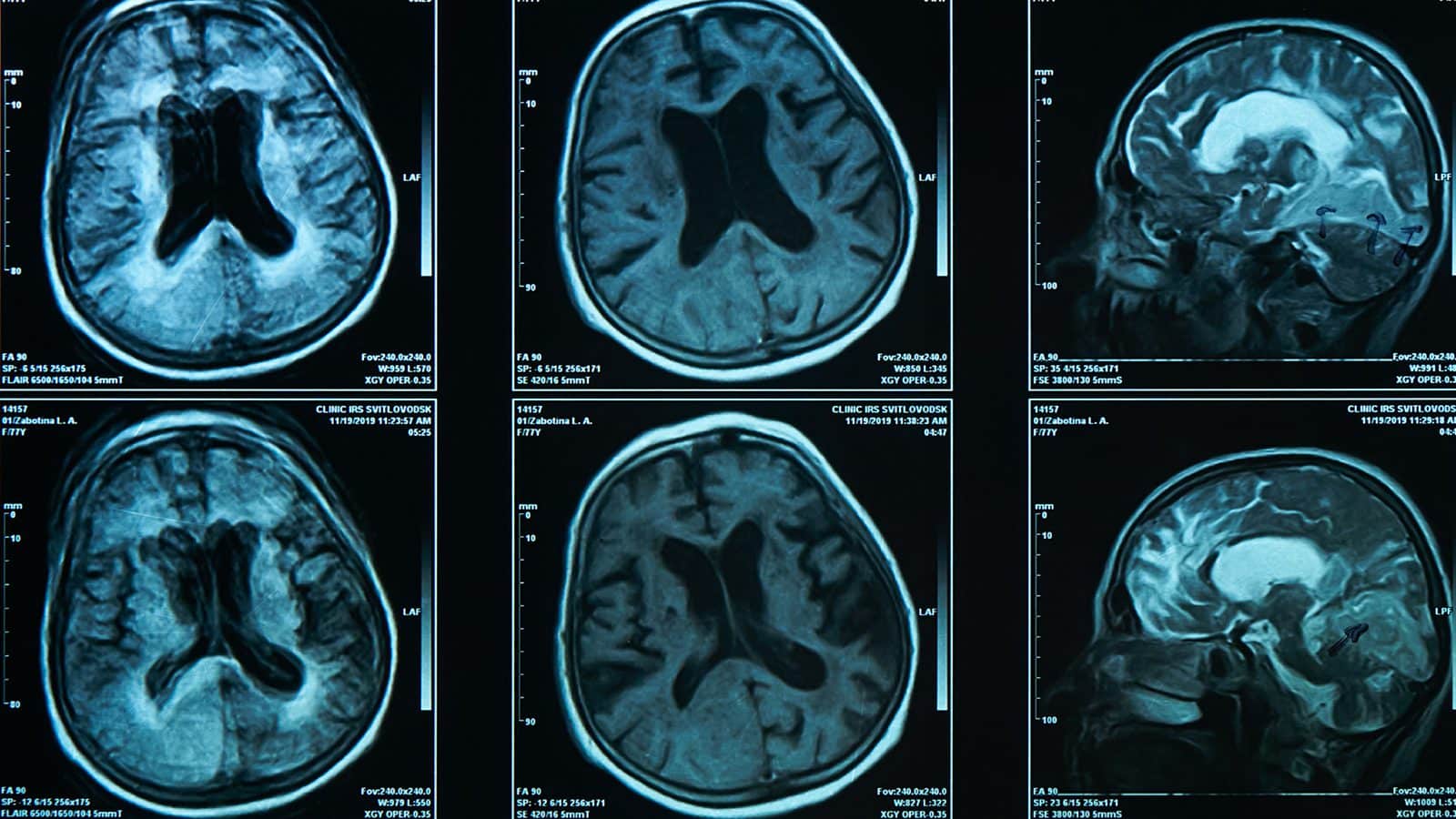 AI Brain Scan Diagnoses Alzheimers Correctly 98% of the Time