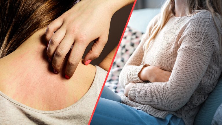 Food Allergy Symptoms