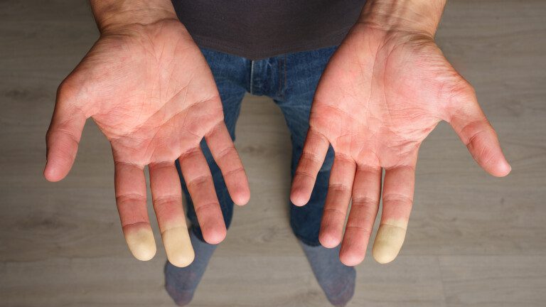 Raynaud's Disease