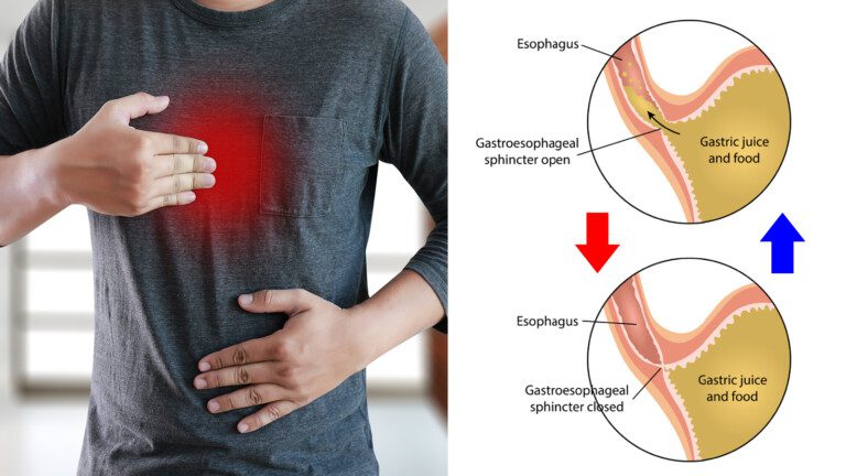 acid reflux