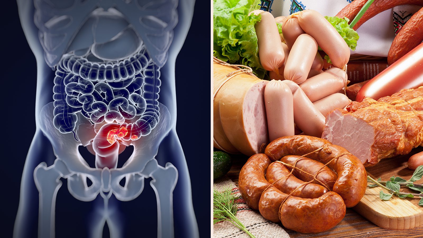 Researchers Reveal Ultra-processed Foods May Cause Colorectal Cancer