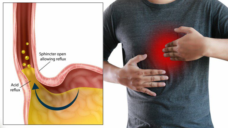 acid reflux