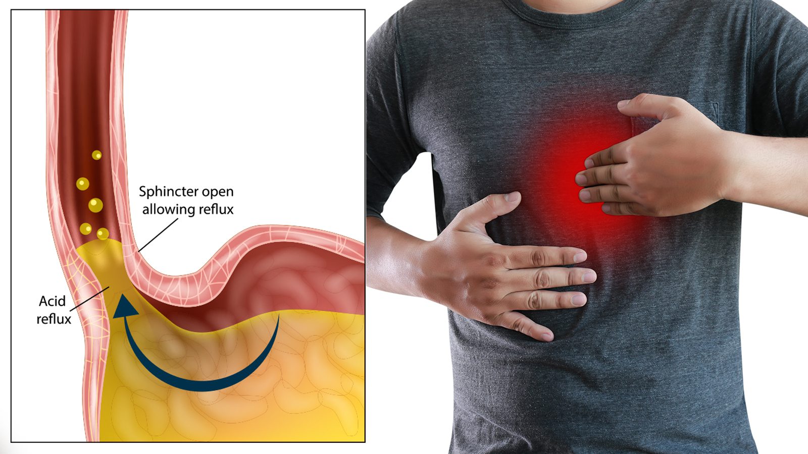 5 Things That Cause Acid Reflux (And How to Stop It)