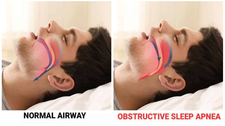 sleep apnea