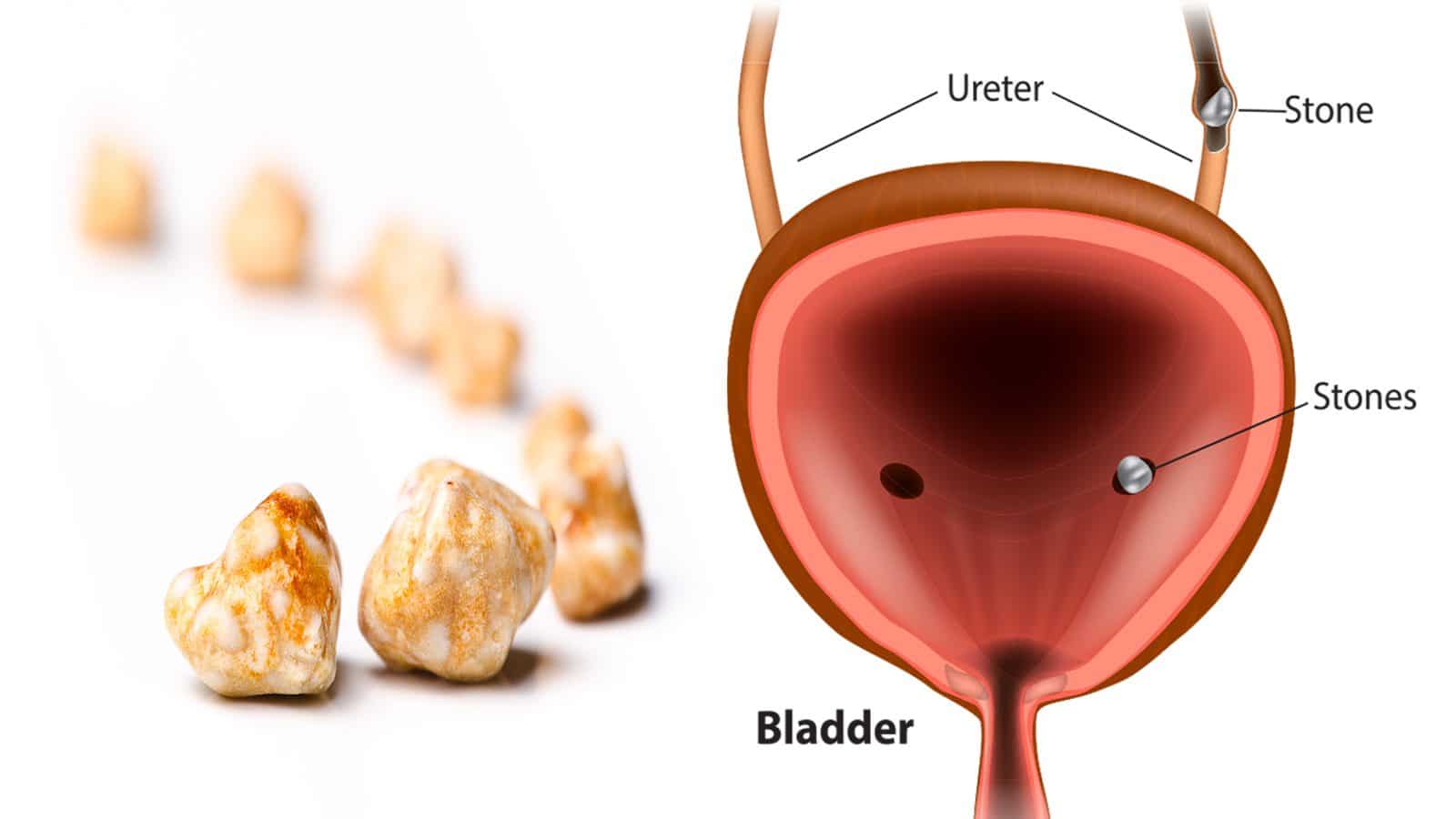 7 Things That Cause Bladder Stones (And How to Prevent Them)