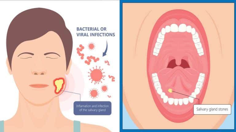 salivary stones