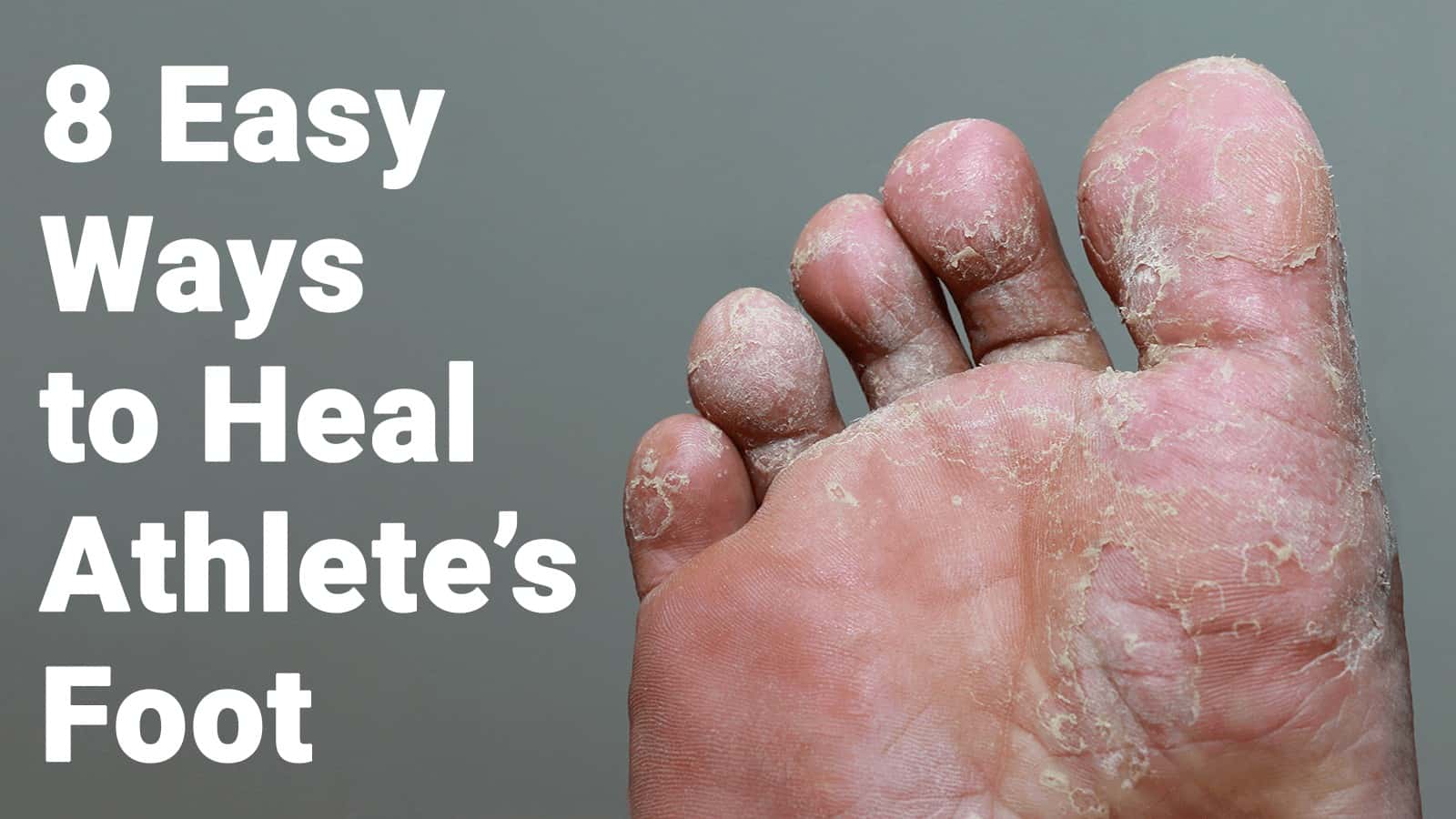 8 Easy Ways to Heal Athlete’s Foot