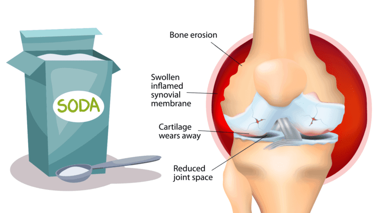 arthritis pain