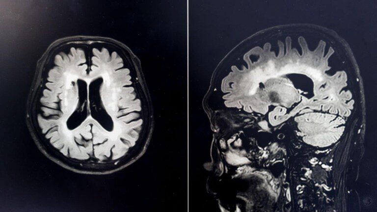 alzheimer's disease