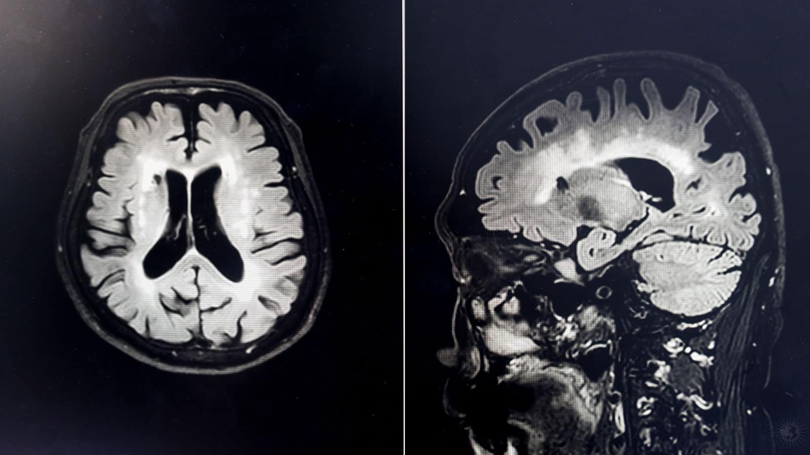 Neurologist Explains 4 Ways to Lower Your Risk of Alzheimer’s Disease