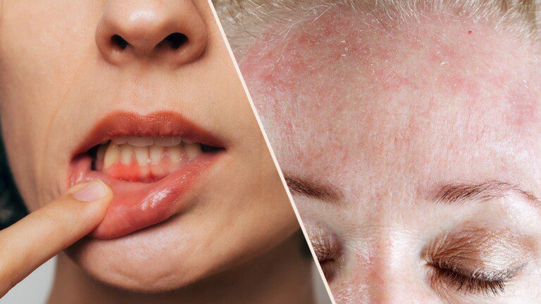 vitamin c deficiency