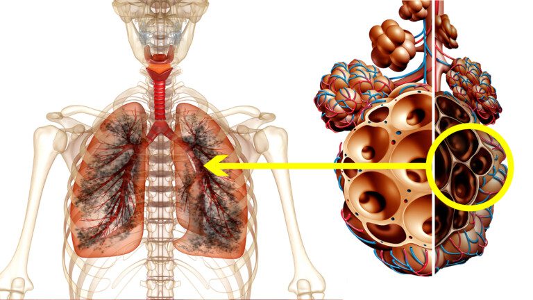 smoking lungs