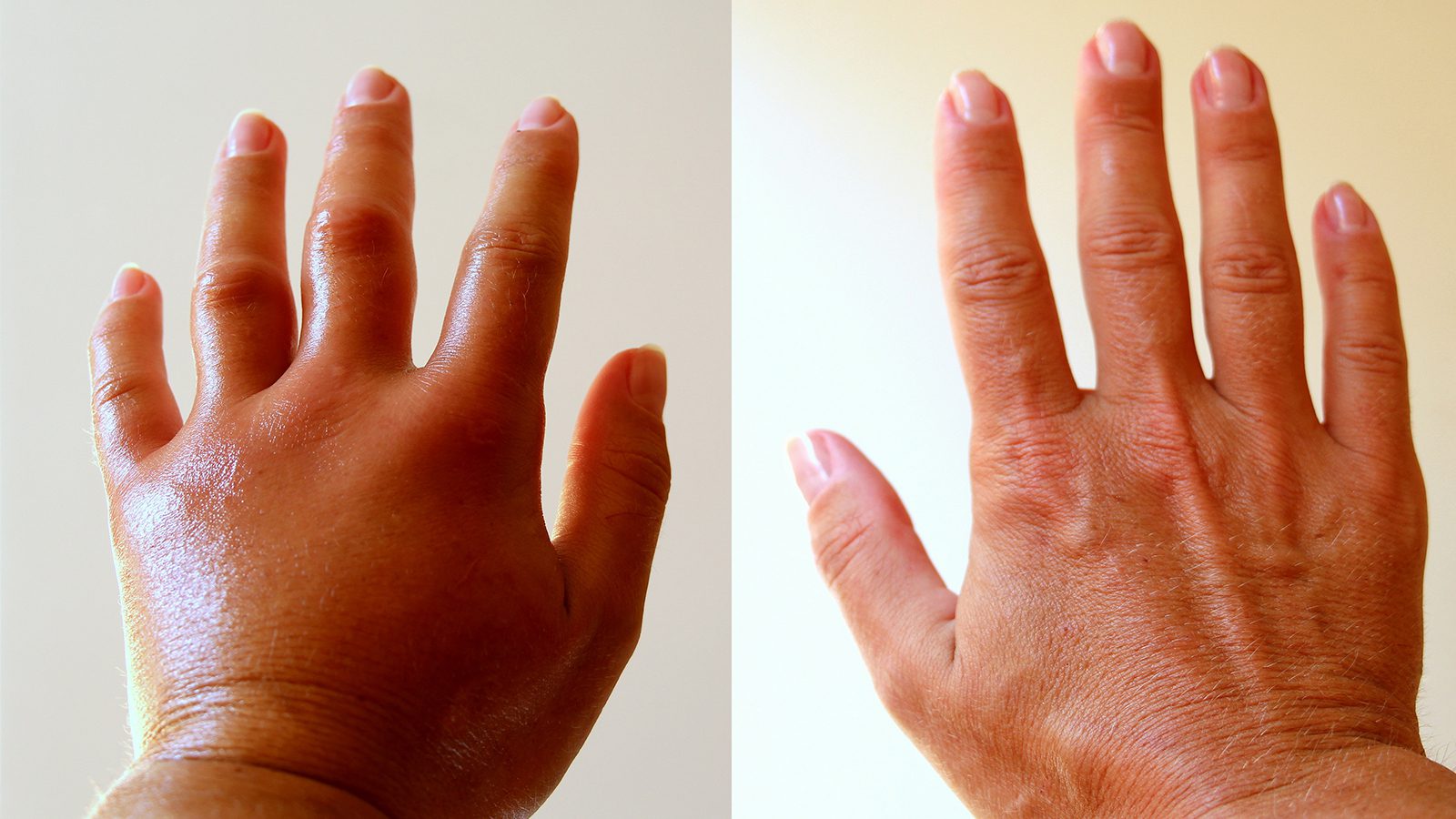 Doctors Explain What Swollen Hands Reveal About Your Health