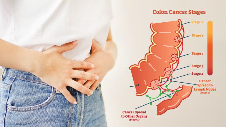 colon cancer