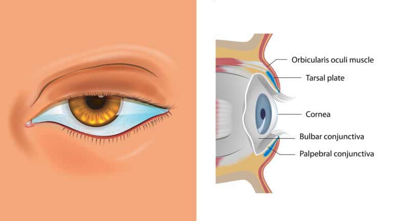 puffy eyelids