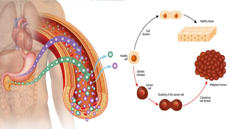 diabetes cancer