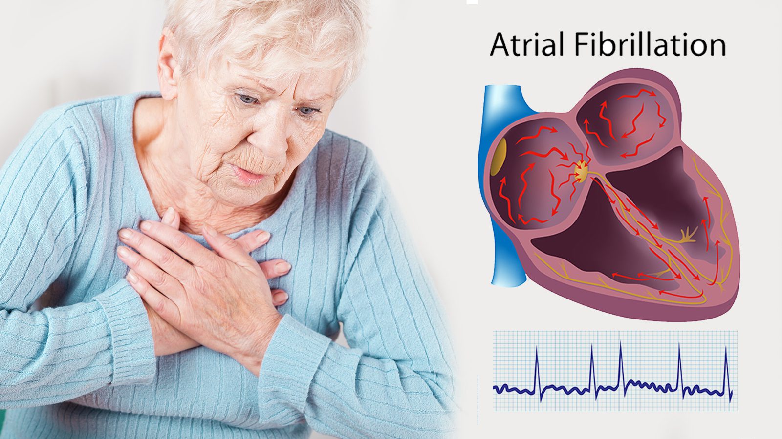 Vitamin D May Protect You From Atrial Fibrillation. According to Science