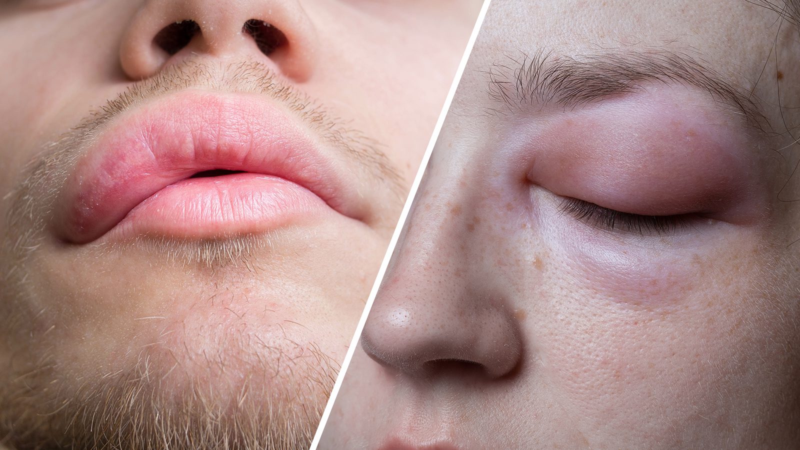 4 Types of Angioedema (and How to Fix It)