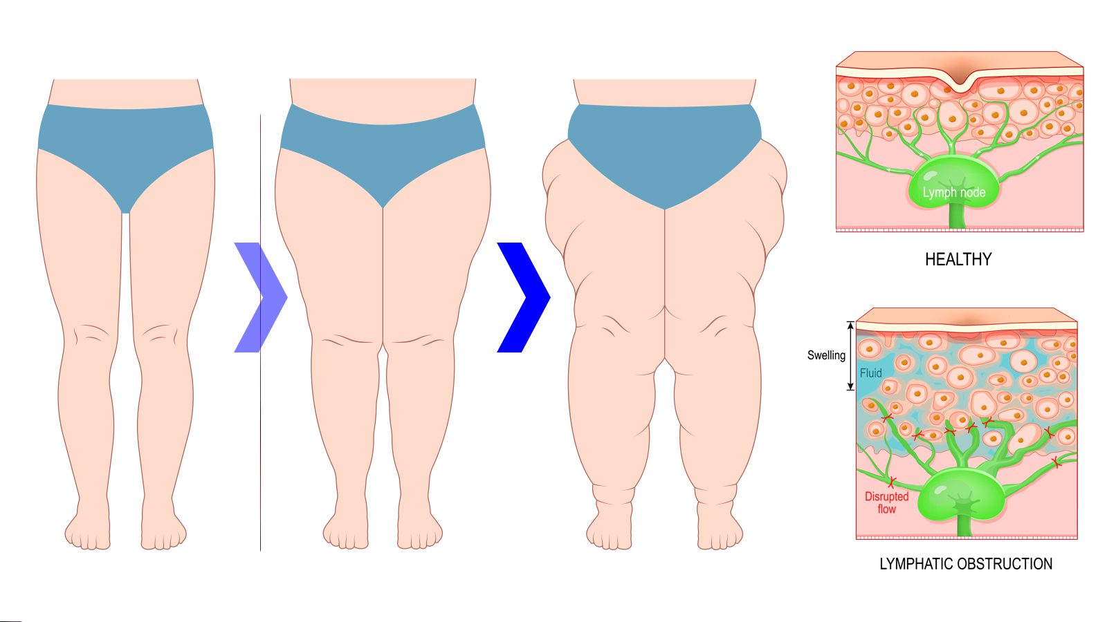 9 Signs of Lipedema (and How to Fix It)