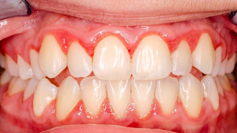 swollen gums