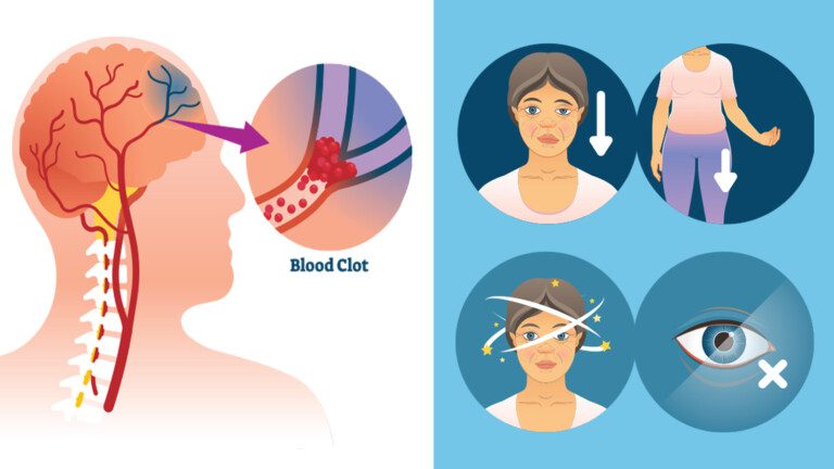 signs of stroke