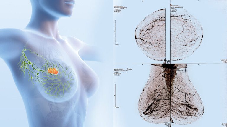 breast cancer symptoms